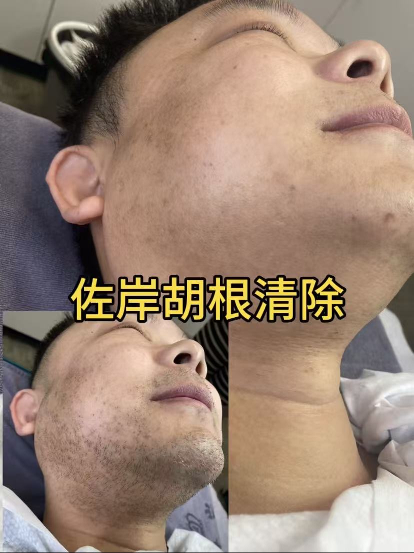 丽水脱毛