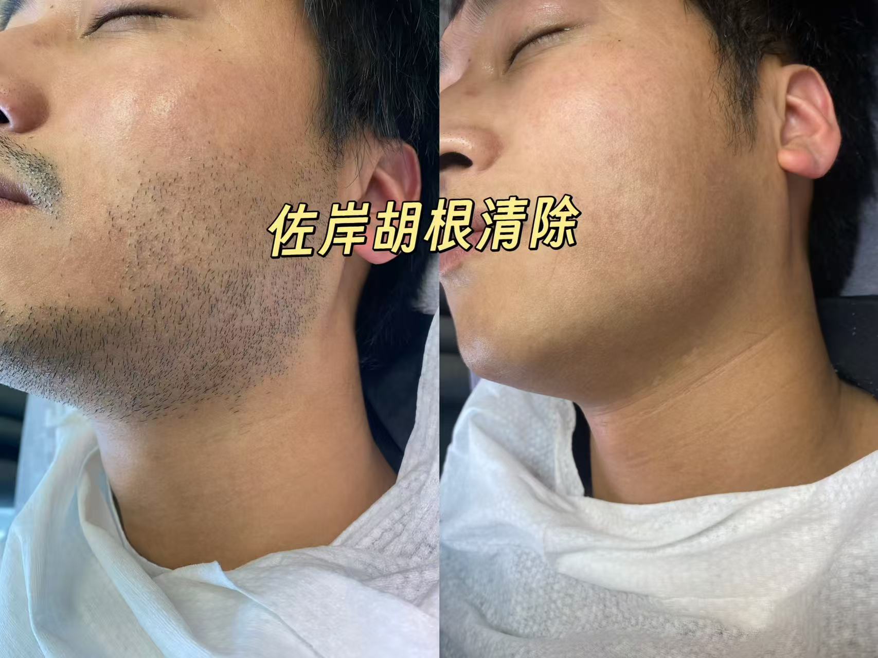 丽水脱胡子
